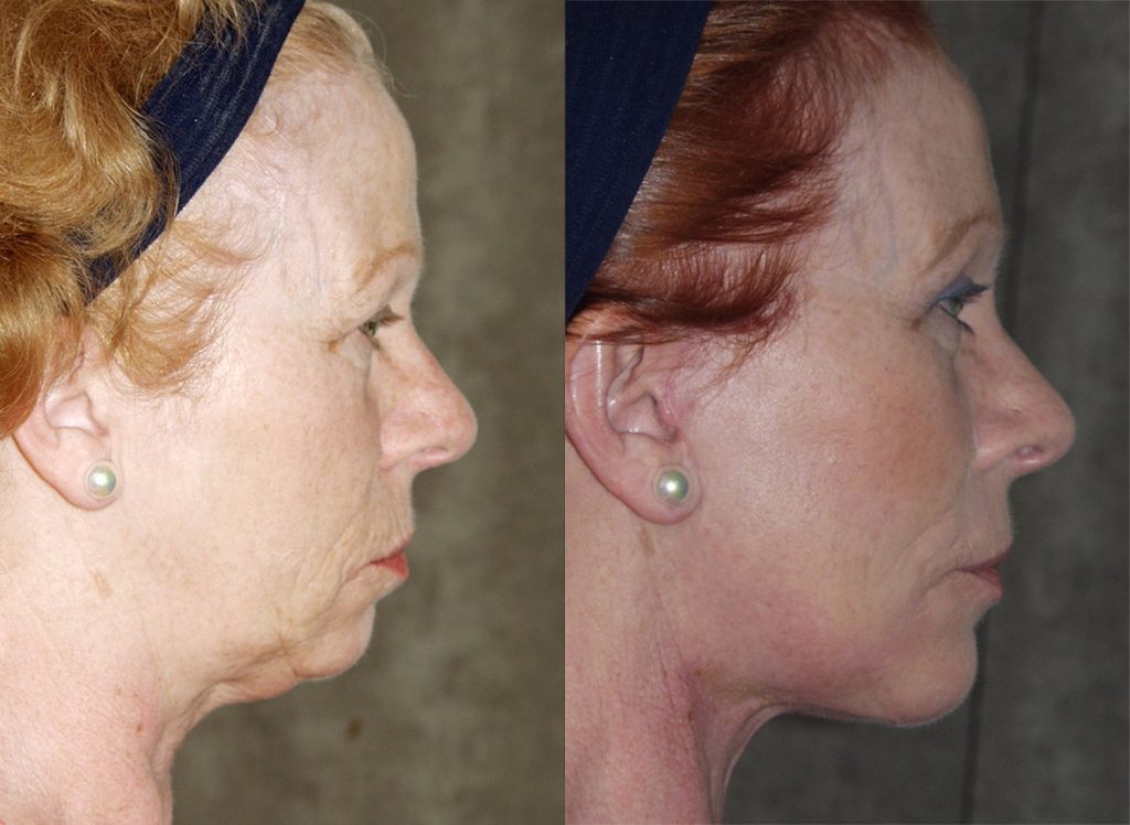 57-year-old-facelift-browlift-upper-lower-eyelids-chin-implant-6-months-side
