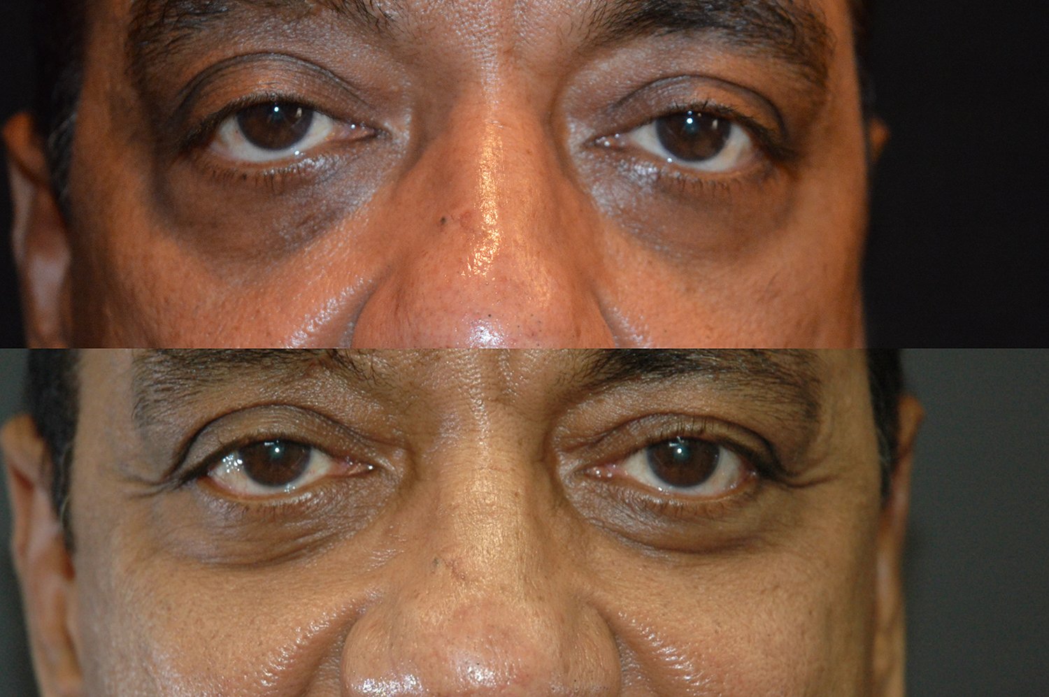 57-year-old lower eyelid transconjunctival bleph w. fat transposition, 2 years after surgery forward gaze