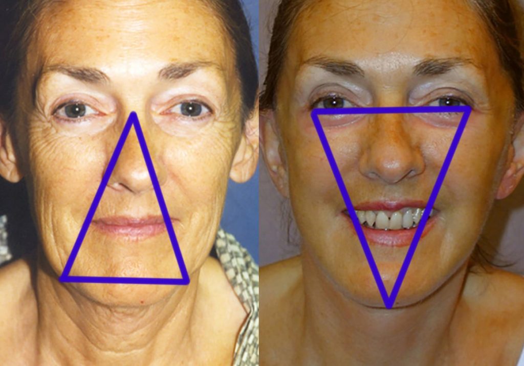 The Inverted Triangle of Youth restored on the right after Facelift Surgery.