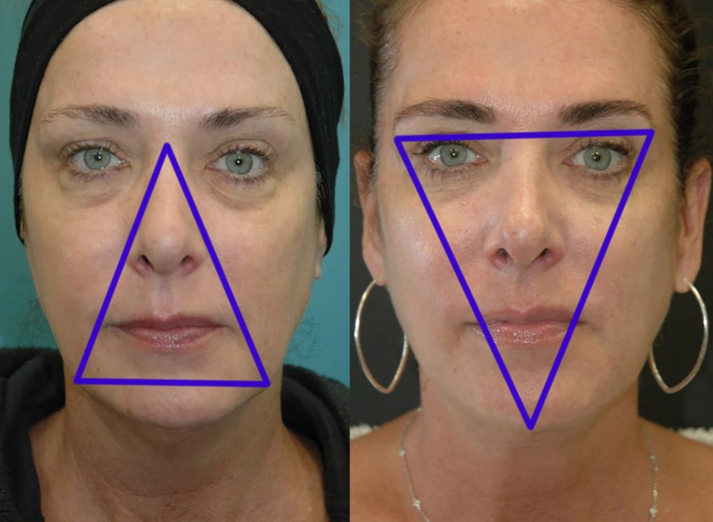 The Inverted Triangle of Youth restored on the right after FaceTite Surgery.