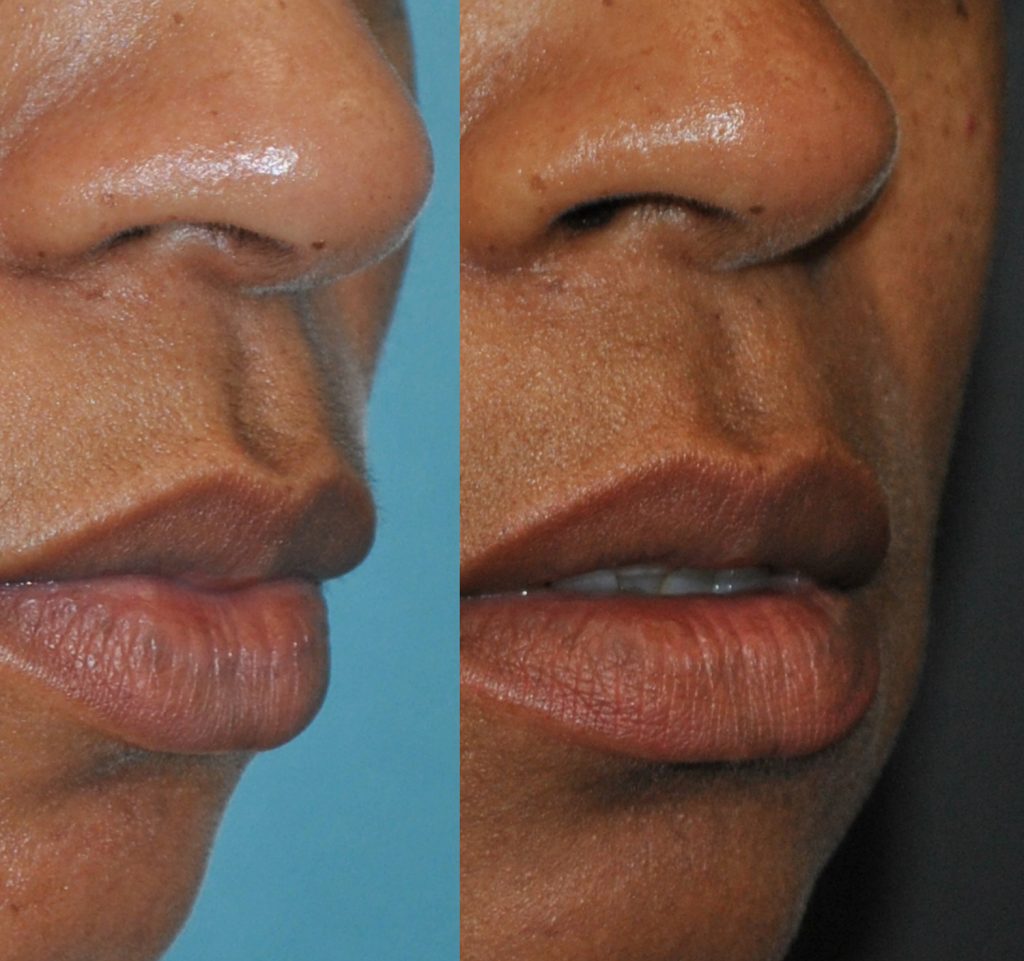 Lip Flip before and after oblique (no filler)