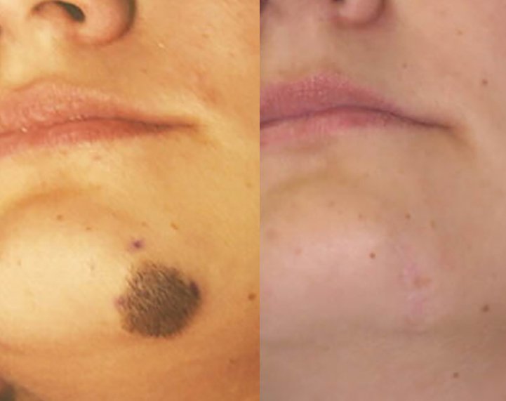 This mole was removed in two stages using a technique known a ’serial excision.’