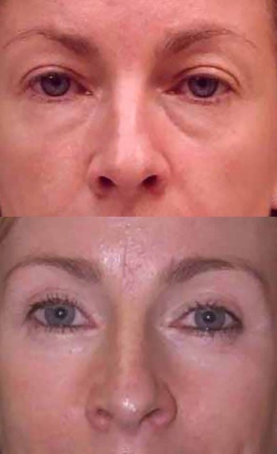 Upper and lower eyelid lift