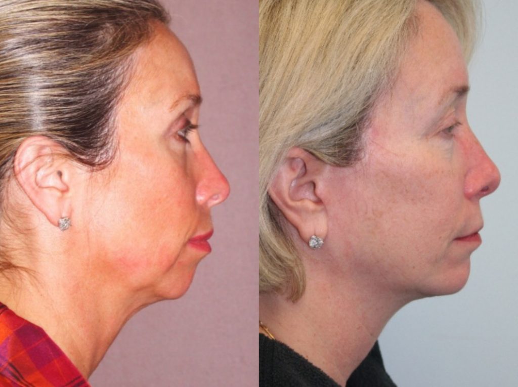 Facelift with chin implant