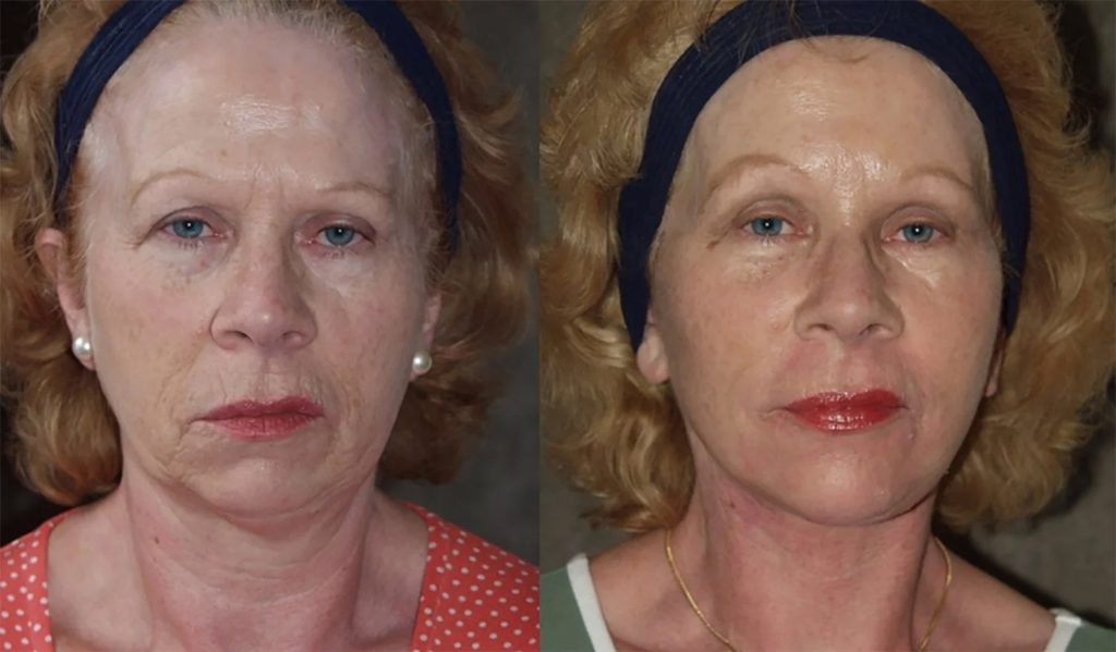 Facelift with browlift, chin implant and peri-oral peel